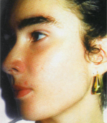 estetica-myr-solucion-acne2