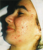 estetica-myr-solucion-acne2a