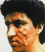 estetica-myr-solucion-acne3a